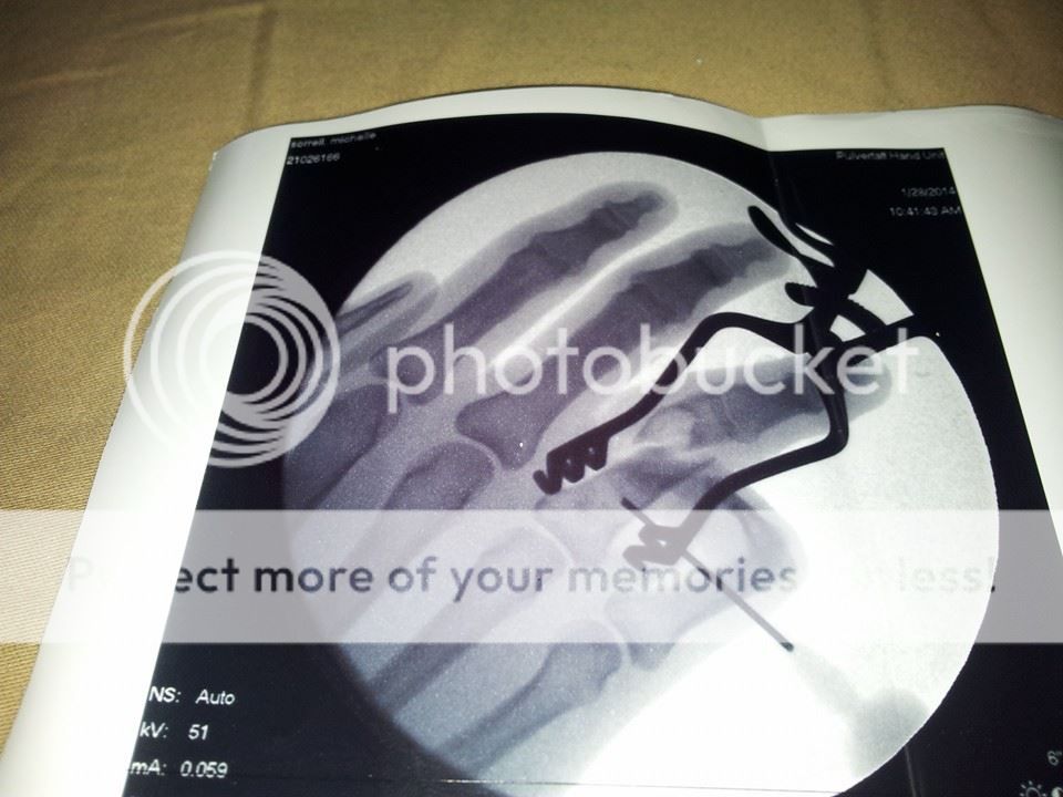 spiral fracture of ring finger